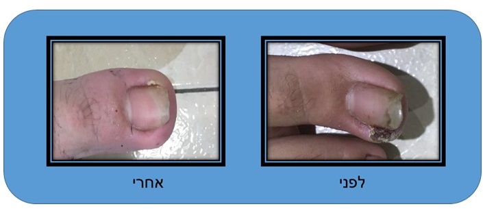 תמונה של ציפורן חודרנית לפני ואחרי תמונה של ציפורן חודרנית לפני ואחרי