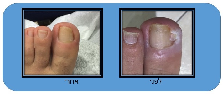 תמונה של ציפורן חודרנית לפני ואחרי תמונה של ציפורן חודרנית לפני ואחרי