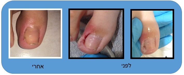 תמונות ציפורן חודרנית לפני ואחרי תמונות ציפורן חודרנית לפני ואחרי